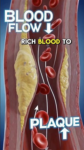 What a Clogged Artery Looks Like Inside Your Body 🫀