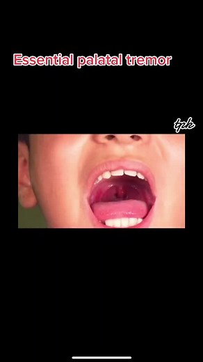 Understanding Palatal Tremor: Causes and Symptoms