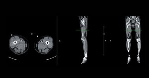 Ct Venogram Leg Non-invasive Imaging Procedure Stock Footage Video (100% Royalty-free) 3429850933 | Shutterstock