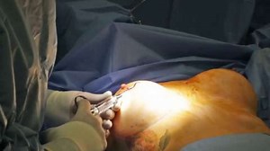 Breast Augmentation Revision:  See the Doctor Perform a Capsulopexy in 2 Minutes