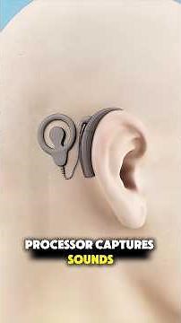 Cochlear implant surgery #3dmedicalanimation #medical3danimation #cochlearimplant #cochlear #ear