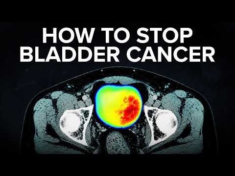 Bladder Cancer Explained: Risk Factors, Symptoms & Treatment
