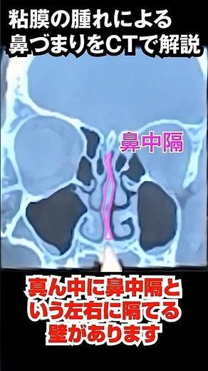 鼻づまりが「骨を削る」だけで治る理由【耳鼻科医が解説】