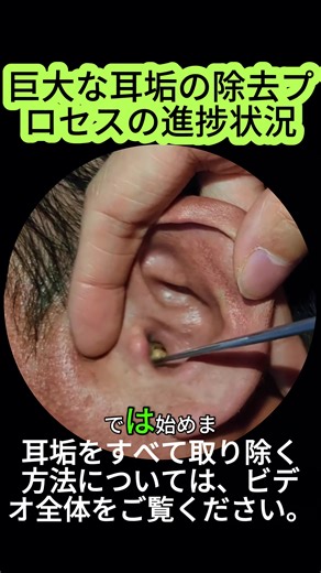 #satisfyingvideos#asmr #satisfying #satisfyingvideos #satisfyingsounds #earwax #earwaxremoval #earcleaning #耳掃除 #耳垢ナカショー #耳垢掃除 #asmr #asmrsounds #耳垢掃除