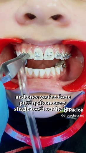 Braces Process: Step by Step Guide for New Wearers