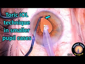 Toric IOL technique in small pupil cataract surgery