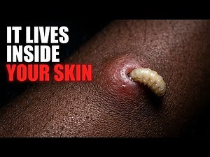 Botfly Larvae Are Living Under Your Skin Right Now — Here's Why Removal Is Impossible 🪰