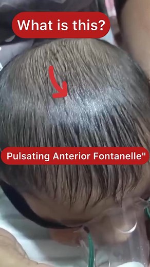 A pulsatile anterior fontanelle in babies is usually normal, caused by blood flow matching the heartbeat. It becomes more visible when crying or straining. However, a bulging fontanelle (with fever, vomiting, or irritability) may signal increased pressure, while a sunken fontanelle suggests dehydration. #anteriorfontanelle #kids #moms #newborn #momhelpingmom #parenting #momsofinstagram #momssupportingmoms #surat #india #moms #reels | Santosh Yadav