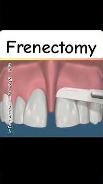 Frenectomy: Closes or prevents a gap between front teeth#orthodontics