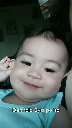 Understanding Dermoid Cysts in Babies - Causes and Treatment