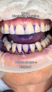 ✨2TONE DISCLOSING SOLUTION✨ It reveals both older AND newer plaque with an advanced multicolored formula! 🔴 Newer plaque—>pink/red color 🔵 Older plaque—> blue color This helps to show the patients the areas they consistently miss while brushing. 2Tone is an excellent way to motivate your patients and educate them on their OHI! #YoungInnovations #YoungDental #YoungSpecialties #2Tone #Dentaldisclosing #Disclosingsolution Do you feel that by disclosing your patients they are more motivated? 🦷🪥 