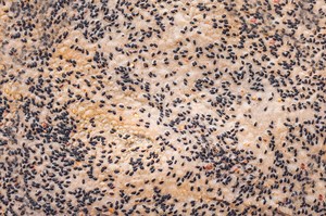 Watch Dr. Pimple Popper Pop Juicy Blackheads All Over This Man's Face