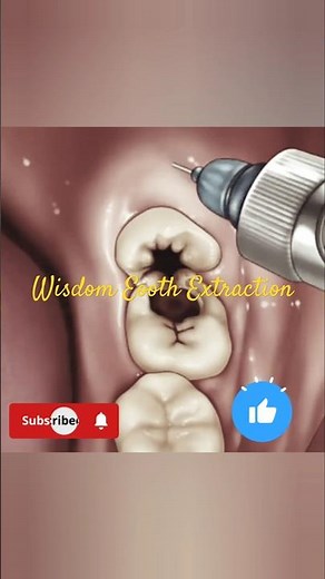 Wisdom Tooth Extraction: The Most Satisfying Animation