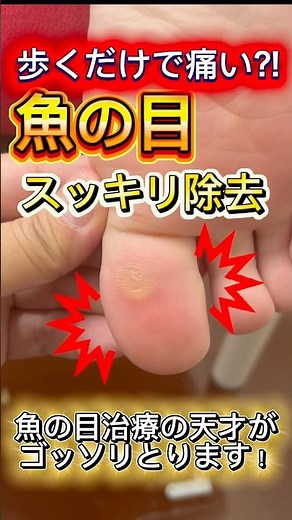 歩くだけで痛い魚の目 魚の目治療の天才が治す！＃巻き爪＃スッキリ＃ネイル＃魚の目