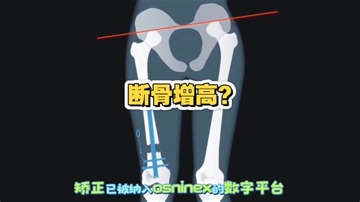 Fitbone骨延长系统:断骨增高？