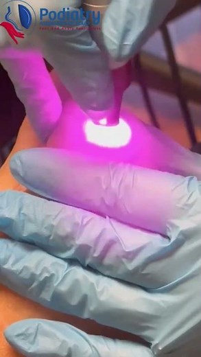 ⚡️Laser treatment 👣