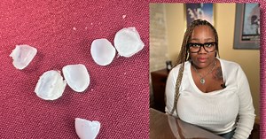 ‘I’m scarred for life’: Woman sues unlicensed ‘fake dentist’ in Milwaukee after veneers ruin her teeth