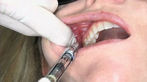 Posterior Superior Alveolar Injection Technique