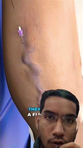 Varicose Veins ka ilaj laser se #shorts #youtubeshorts #ytshorts #health #doctor #medical