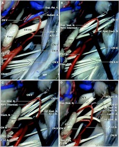 Geniculate Neuralgia | Cohen Collection | Volumes | The Neurosurgical Atlas