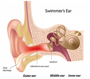 Swimmers Ear | Introduction, Symtoms & Treatment