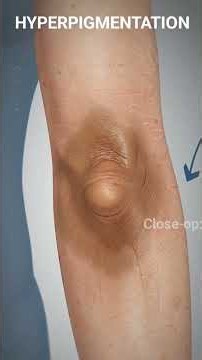 Addison’s Disease: The Hidden Condition You Need to Know