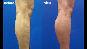 Calf Implant Augmentation with Non-rupturable Silicone Calf Implant by Dr. Kevin Tehrani (GRAPHIC)