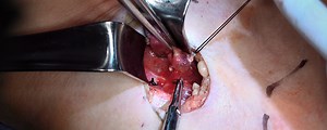 Minimally Invasive Parathyroidectomy Under Local Cervical Block Anesthesia for Primary Hyperparathyroidism and Parathyroid Adenoma | Journal of Medical Insight