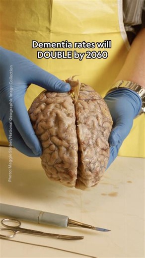 Dementia rates in the U.S. are expected to double by 2060. While this statistic might sound alarming, it actually represents good news: more Americans are getting dementia later in life because they're living longer. Learn more about rising dementia rates and how to reduce your risk: https://on.natgeo.com/3UTYYrr Host: Keren Landman | National Geographic