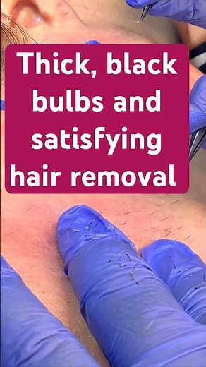 Satisfying Electrolysis during active hair growth phase. Permanent hair removal for PCOS, Hirsutism