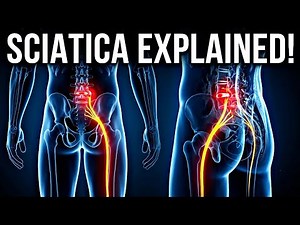 Sciatica Explained: Causes, Symptoms, MRI, Exercises & Treatment | Complete Guide