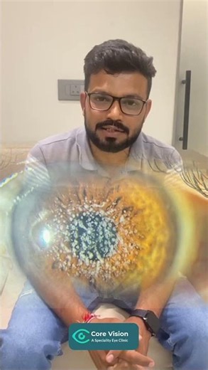 PTK Laser Patient Testimonial | Granular Corneal Dystrophy 👁️✨