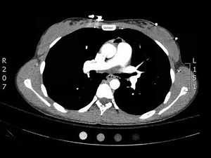 Chest Pneumomediastinum, Axial CT. JETem 2018