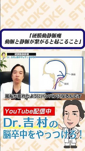 硬膜動静脈瘻 動脈と静脈が繋がると起こること #硬膜動静脈瘻 #治療法 #脳卒中 #脳出血 #くも膜下出血 #兵庫医科大学 #医学生 #研修医