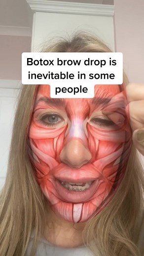 Understanding the Botox Brow Drop Phenomenon