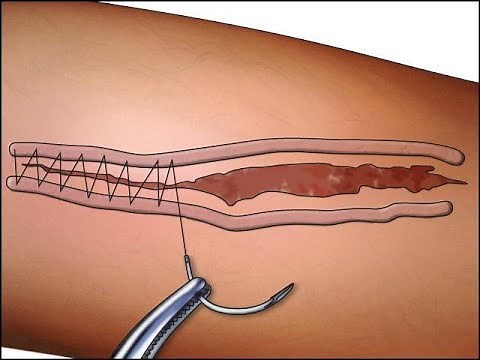 suture chirurgicale technique,,apprendre à suturer..points de suture technique