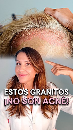 Dra Maria Marcos on Instagram: "💆‍♀️ ¿Tienes granitos en el cuero cabelludo? No es acné… y apretarlos puede empeorar la situación. Muchas veces se confunden, pero en realidad suelen ser foliculitis: una inflamación del folículo piloso que puede aparecer en la nuca o entre el pelo y que, si se manipula, puede empeorar o dejar marcas. ¿Te ha resultado útil? Compártelo con quien lo necesite."
