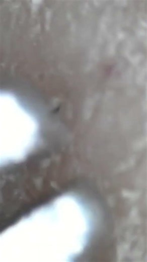 根元だけ真っ黒な毛 #毛抜き #hairplucking #抜毛症