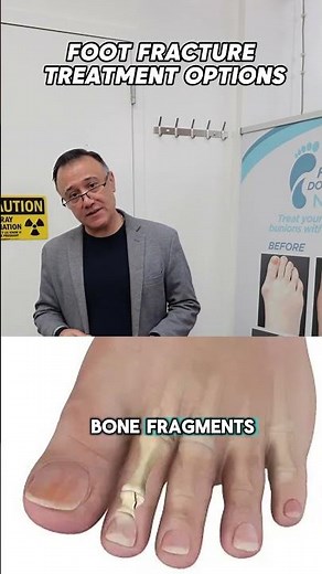 Foot fractures: what you need to know!