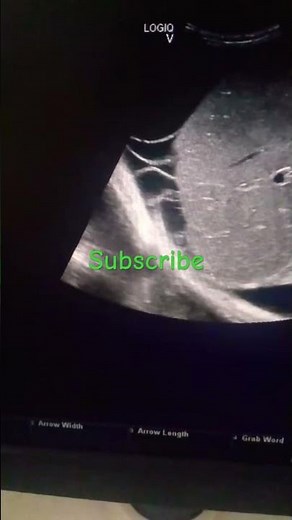 Sclerosing peritonitis
