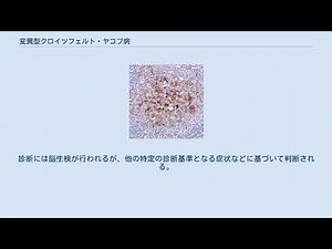 変異型クロイツフェルト・ヤコブ病