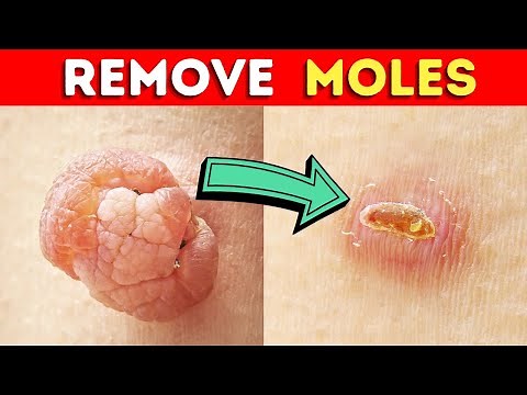How to Remove a Mole Quickly With Castor Oil