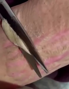 Self harm part thighs with scissors