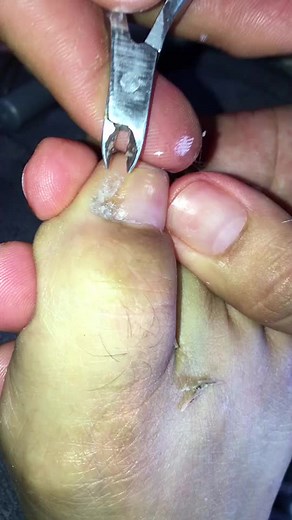 Professional Ingrown Toenail Removal at Sherwin Ladrido Salon