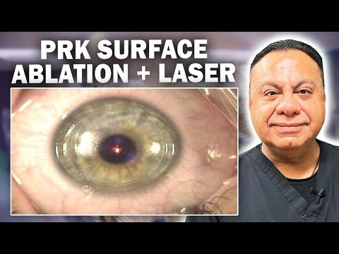PRK Surface Ablation with Laser Eye Treatment