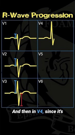 Understanding R Wave Progression