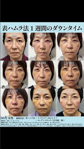 【クマ取り】表ハムラ法と脂肪注入のダウンタイム大公開⭐️#美容整形 #クマ取り #裏ハムラ法 #表ハムラ法 #整形 #目の下のふくらみ取り #ダウンタイム #美容#湘南美容クリニック