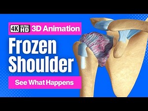 Frozen Shoulder (Adhesive Capsulitis) - 4K 3D Animation