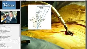 The Three Principles of MIS Surgery in the Lumbar Spine