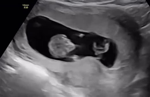 Feetal Hospital on Instagram: "At #11weeks, you’re due for NT scan to check for any abnormalities. Pregnancy Scan now costs N10,000 @FeetalHospital . We also offer these Important Investigative Scans; . °Nuchal Translucency Scan (11-13weeks) °Breast Scan °Neck Scan °Pelvic Scan °Abdominal Scan °Prostate Scan for Men °Testicular Scan for Men °Anomaly Scan (18-25weeks) °BioPhysical Profile Scan (33+ weeks) °Fetal Sex determination scan °Follicular tracking scan °Fetal Activity Scan . And all other